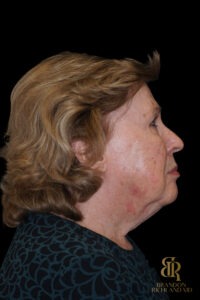 Brow Lift before and after, Case #11800 — Dr. Brandon Richland, Newport Beach
