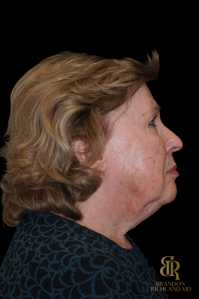 Brow Lift Before, Case #11800, view 3 — Dr. Brandon Richland, Newport Beach