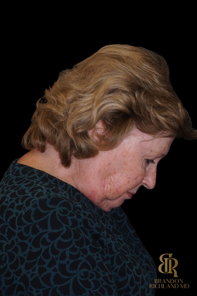 Brow Lift Before, Case #11800, view 4 — Dr. Brandon Richland, Newport Beach