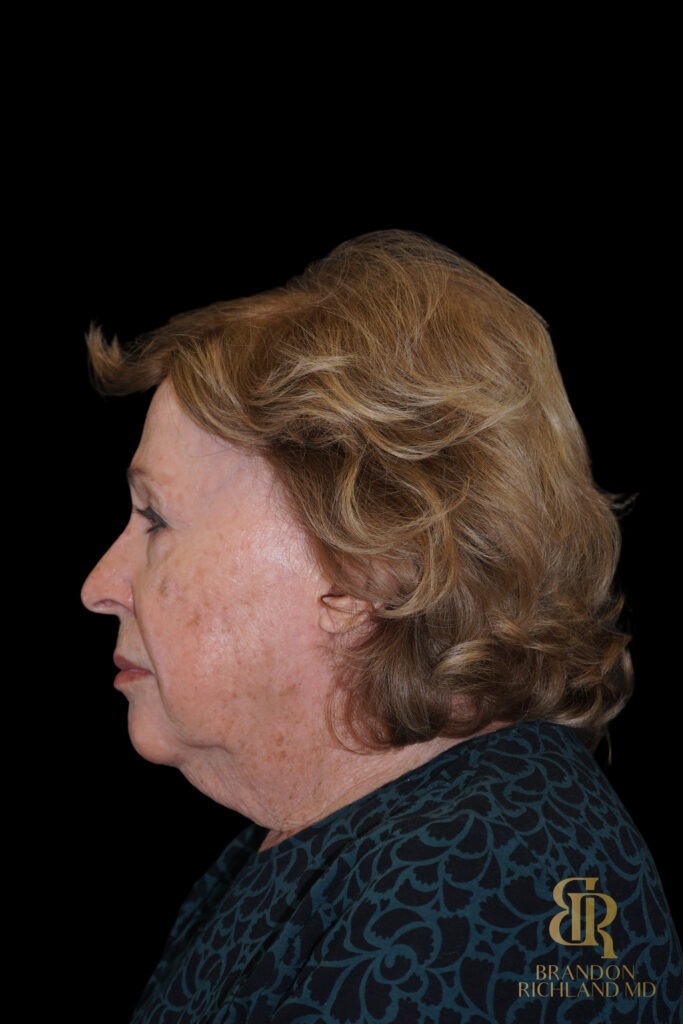 Brow Lift Before, Case #11800, view 6 — Dr. Brandon Richland, Newport Beach