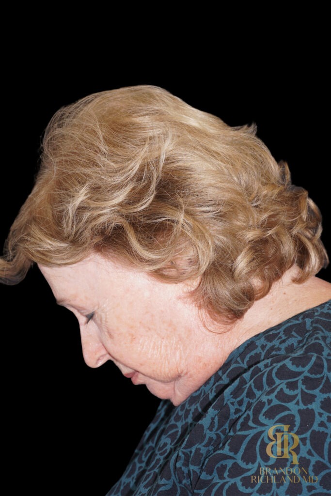 Brow Lift Before, Case #11800, view 7 — Dr. Brandon Richland, Newport Beach