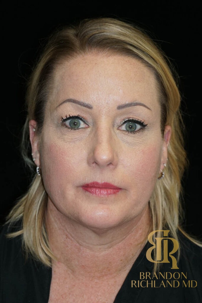 Blepharoplasty Before, Patient 12, view 1 — Dr. Brandon Richland, Newport Beach