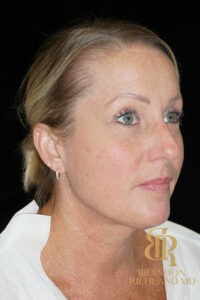 Blepharoplasty before and after, Patient 12 — Dr. Brandon Richland, Newport Beach