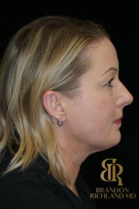 Blepharoplasty before and after, Patient 12 — Dr. Brandon Richland, Newport Beach
