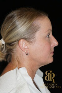Blepharoplasty before and after, Patient 12 — Dr. Brandon Richland, Newport Beach