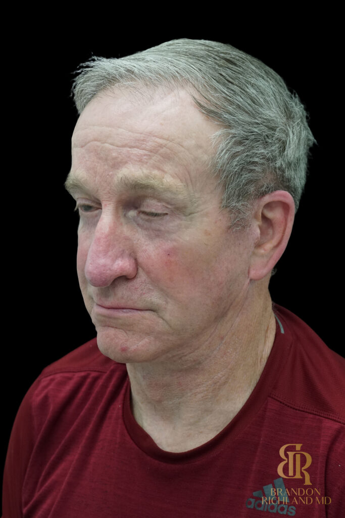 Brow Lift After, Case #51907, view 4 — Dr. Brandon Richland, Newport Beach