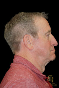 Brow Lift before and after, Case #51907 — Dr. Brandon Richland, Newport Beach