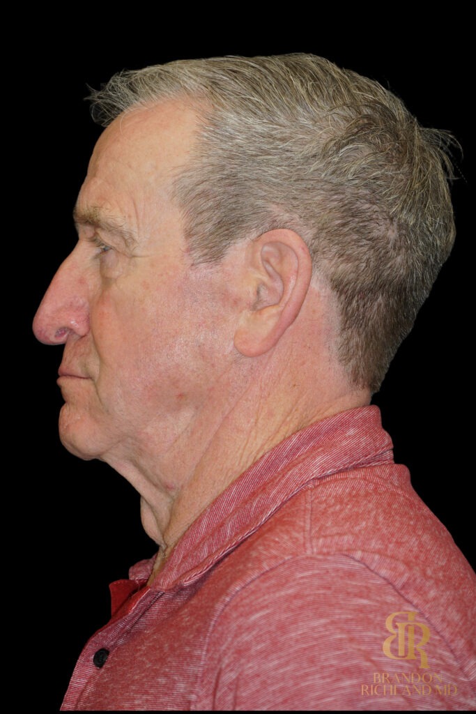 Brow Lift Before, Case #51907, view 5 — Dr. Brandon Richland, Newport Beach