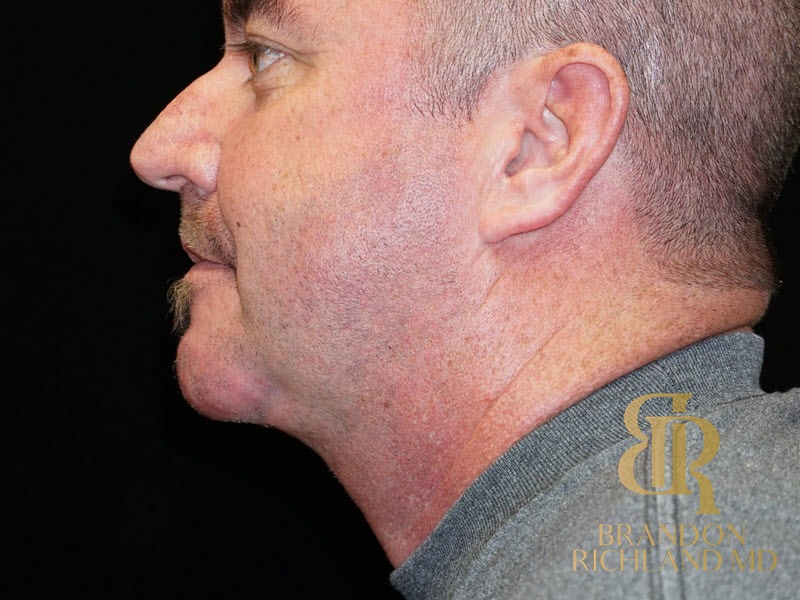Facelift & Neck Lift After, Patient 01, view 2 — Dr. Brandon Richland, Newport Beach