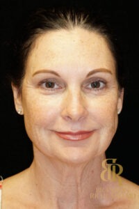 Facelift & Neck Lift before and after, Patient 02 — Dr. Brandon Richland, Newport Beach