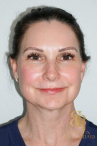 Facelift & Neck Lift before and after, Patient 02 — Dr. Brandon Richland, Newport Beach