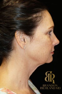Facelift & Neck Lift before and after, Patient 02 — Dr. Brandon Richland, Newport Beach