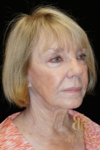 Facelift & Neck Lift before and after, Patient 03 — Dr. Brandon Richland, Newport Beach
