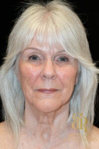 Facelift & Neck Lift before and after, Patient 04 — Dr. Brandon Richland, Newport Beach