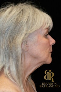 Facelift & Neck Lift before and after, Patient 04 — Dr. Brandon Richland, Newport Beach
