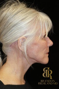 Facelift & Neck Lift before and after, Patient 04 — Dr. Brandon Richland, Newport Beach