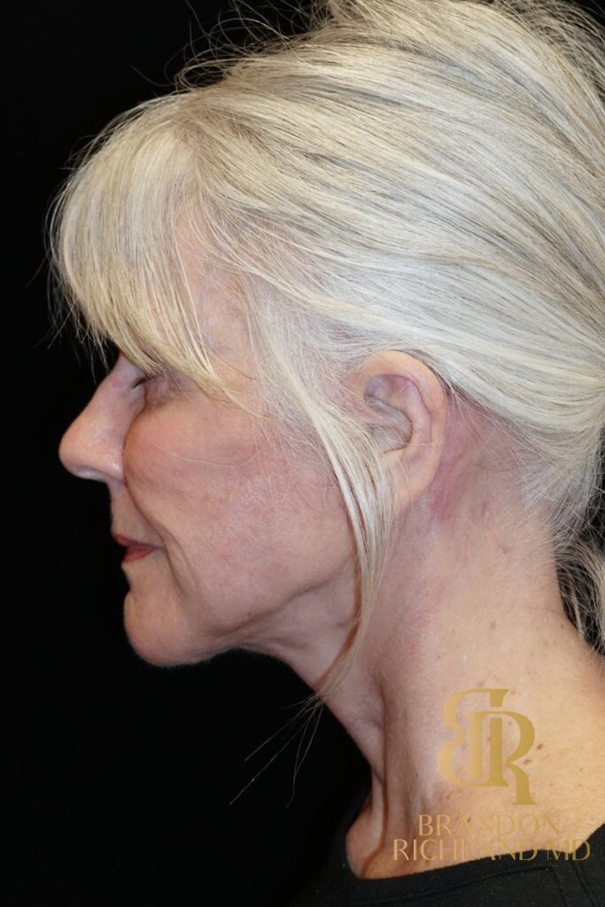 Facelift & Neck Lift After, Patient 04, view 6 — Dr. Brandon Richland, Newport Beach