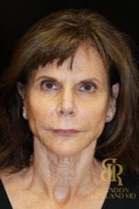 Facelift & Neck Lift before and after, Patient 05 — Dr. Brandon Richland, Newport Beach