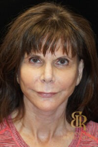 Facelift & Neck Lift before and after, Patient 05 — Dr. Brandon Richland, Newport Beach