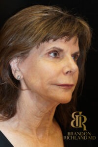 Facelift & Neck Lift before and after, Patient 05 — Dr. Brandon Richland, Newport Beach