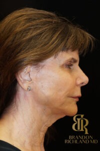 Facelift & Neck Lift before and after, Patient 05 — Dr. Brandon Richland, Newport Beach