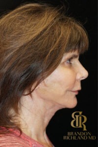 Facelift & Neck Lift before and after, Patient 05 — Dr. Brandon Richland, Newport Beach