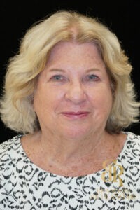 Facelift & Neck Lift before and after, Patient 06 — Dr. Brandon Richland, Newport Beach