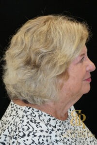 Facelift & Neck Lift before and after, Patient 06 — Dr. Brandon Richland, Newport Beach