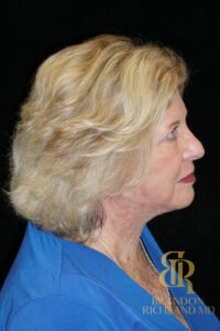 Facelift & Neck Lift before and after, Patient 06 — Dr. Brandon Richland, Newport Beach