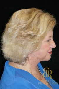 Facelift & Neck Lift before and after, Patient 06 — Dr. Brandon Richland, Newport Beach