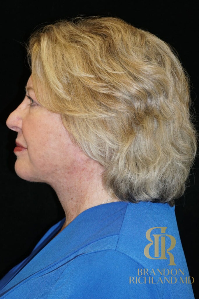 Facelift & Neck Lift After, Patient 06, view 4 — Dr. Brandon Richland, Newport Beach