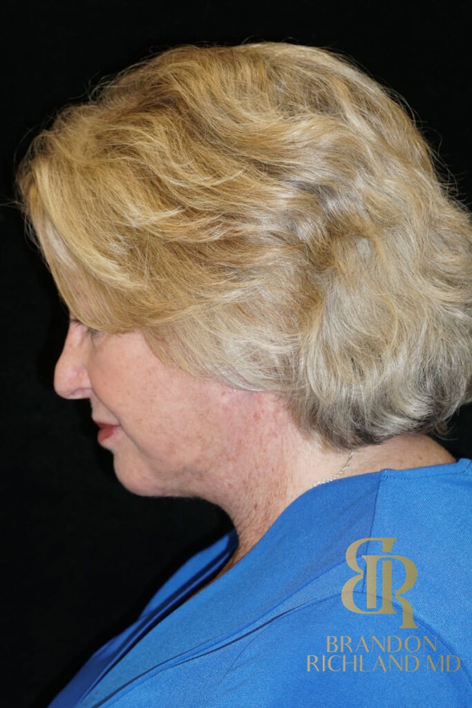 Facelift & Neck Lift After, Patient 06, view 5 — Dr. Brandon Richland, Newport Beach