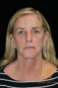 Facelift & Neck Lift before and after, Patient 07 — Dr. Brandon Richland, Newport Beach