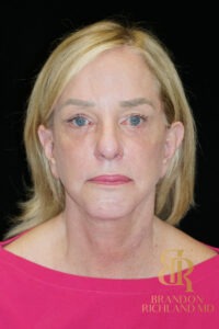 Facelift & Neck Lift before and after, Patient 07 — Dr. Brandon Richland, Newport Beach