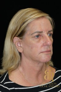 Facelift & Neck Lift before and after, Patient 07 — Dr. Brandon Richland, Newport Beach