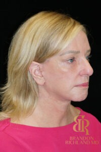 Facelift & Neck Lift before and after, Patient 07 — Dr. Brandon Richland, Newport Beach