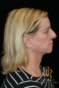 Facelift & Neck Lift before and after, Patient 07 — Dr. Brandon Richland, Newport Beach