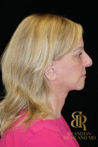 Facelift & Neck Lift before and after, Patient 07 — Dr. Brandon Richland, Newport Beach
