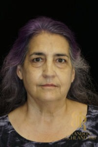 Facelift & Neck Lift before and after, Patient 08 — Dr. Brandon Richland, Newport Beach