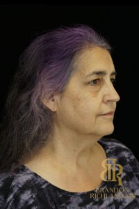 Facelift & Neck Lift before and after, Patient 08 — Dr. Brandon Richland, Newport Beach