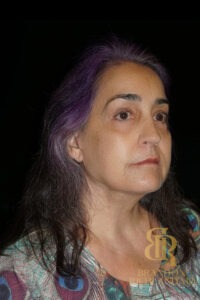 Facelift & Neck Lift before and after, Patient 08 — Dr. Brandon Richland, Newport Beach