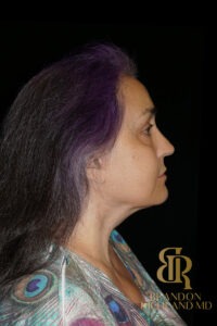 Facelift & Neck Lift before and after, Patient 08 — Dr. Brandon Richland, Newport Beach