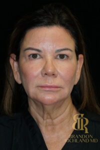 Facelift & Neck Lift before and after, Patient 09 — Dr. Brandon Richland, Newport Beach