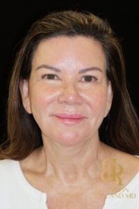 Facelift & Neck Lift before and after, Patient 09 — Dr. Brandon Richland, Newport Beach