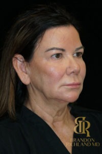 Facelift & Neck Lift before and after, Patient 09 — Dr. Brandon Richland, Newport Beach