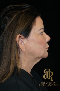 Facelift & Neck Lift before and after, Patient 09 — Dr. Brandon Richland, Newport Beach