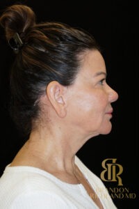 Facelift & Neck Lift before and after, Patient 09 — Dr. Brandon Richland, Newport Beach