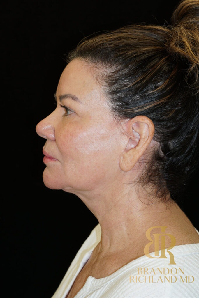 Facelift & Neck Lift After, Patient 09, view 5 — Dr. Brandon Richland, Newport Beach