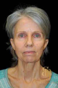 Facelift & Neck Lift before and after, Patient 10 — Dr. Brandon Richland, Newport Beach