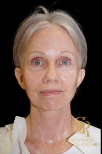 Facelift & Neck Lift before and after, Patient 10 — Dr. Brandon Richland, Newport Beach